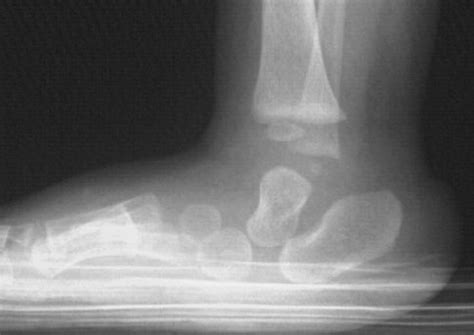 Congenital Vertical Talus - Pediatrics - Orthobullets