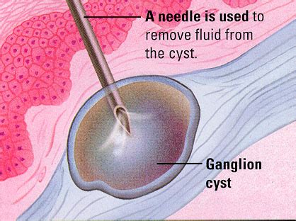 doctorsfootnotes: Ganglion cysts of the foot and Ankle