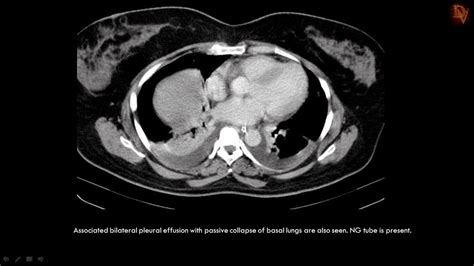 Ultimate Radiology : Acute Necrotizing Pancreatitis