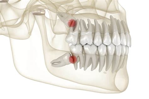 Learn What Will Happen if Wisdom Teeth are Not Removed | Absolute Dental