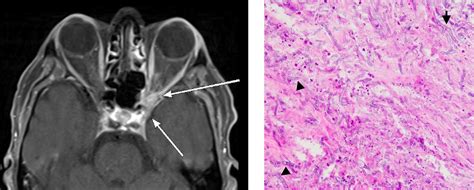 Superior Orbital Fissure Radiology