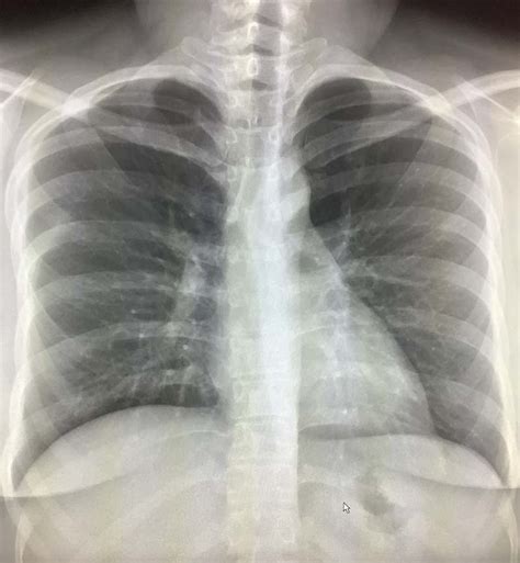 White Spots On Lung X Ray