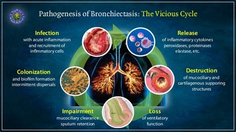 Bronchiectasis - causes and diagnosis