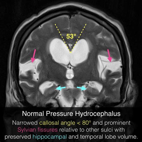 Normal Pressure Hydrocephalus, 57% OFF | gbu-hamovniki.ru