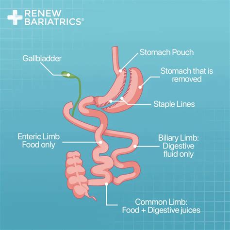 Gastric Sleeve Surgery in Tijuana, Mexico - Renew Bariatrics