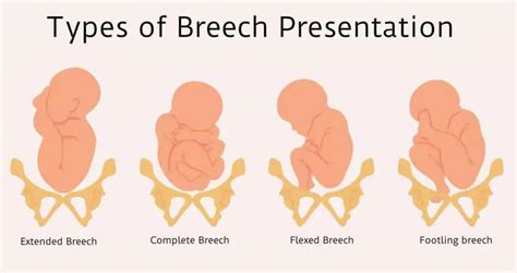 Breech Definition – Types of Breech Presentation, Breech Birth defects and more… - ParentingNMore