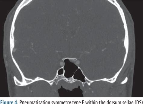 [PDF] Pneumatization of the sphenoid sinus, dorsum sellae and posterior clinoid processes in ...