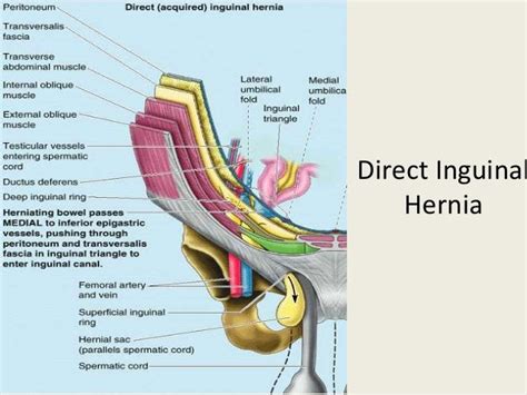 Laparoscopic inguinal hernia repair (TAPP)