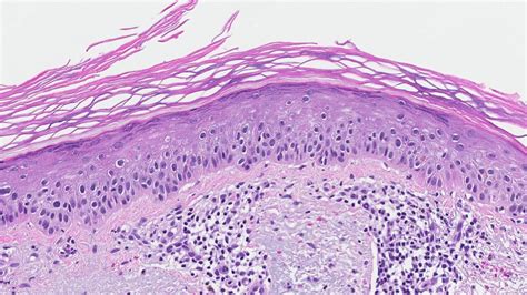 Actinic keratosis | MyPathologyReport.ca