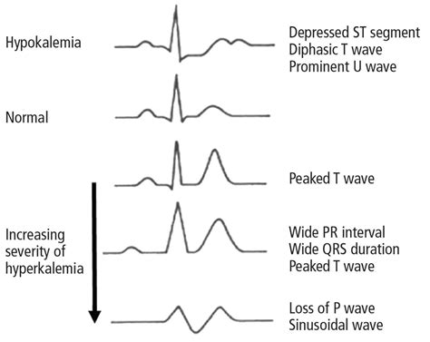 Diagnosis and treatment of hyperkalemia | Cleveland Clinic Journal of Medicine