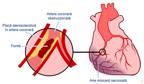 Continental Romance Opiáceo ce simptome ai cand faci infarct temerario Ajuste Lujo