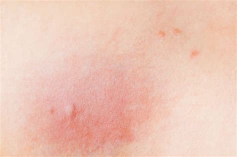 Horsefly bite: How to tell if you've been bitten - what do horsefly bites look like ...