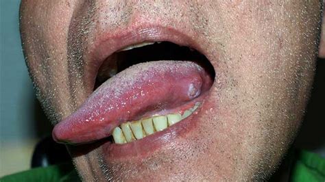 Pictures Of Early Signs Of Tongue Cancer - Infoupdate.org