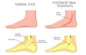 Posterior Tibial Tendonitis - Caruso Foot & Ankle