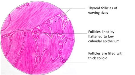 Colloid Goiter - Pathology Made Simple