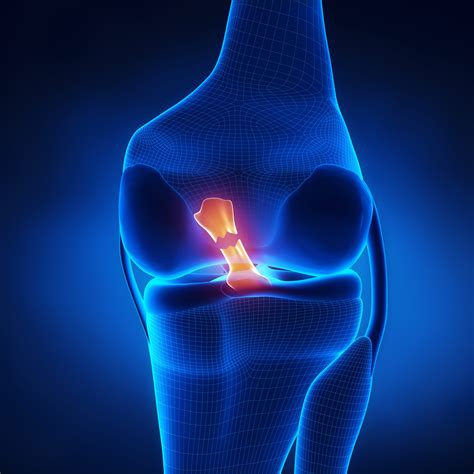 Posterior Cruciate Ligament Injury |PCL Tear | Orthopedic Knee ...