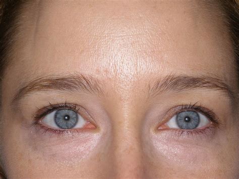 Latisse Patient Before and After Gallery - Advanced Skin Care, Laser & Body Contouring Center