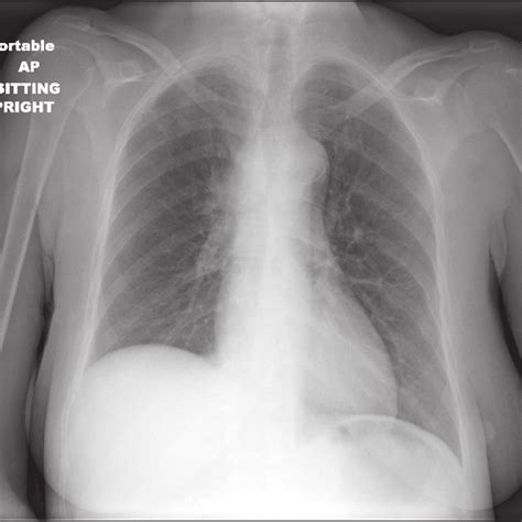 What Causes An Elevated Hemidiaphragm - John Wade Bruidstaart