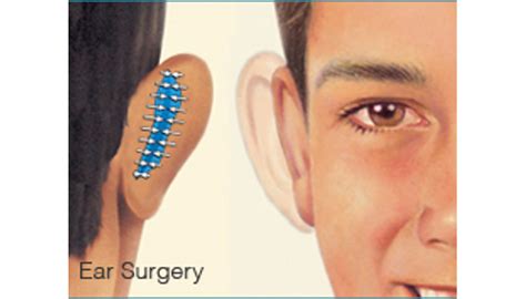 Cosmetic Ear Surgery - Brigham and Women's Hospital