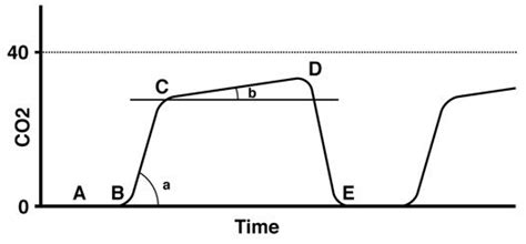 end tidal co2 monitoring waveforms - Kip Ayala