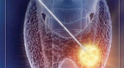 Radiofrequency Ablation of Thyroid Nodules - Atlanta's Advanced Thyroid and Parathyroid Center