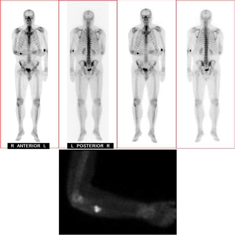 Total body Tc99 nuclear medicine bone scan at presentation shows ...