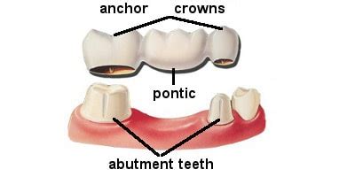 Abutment Teeth