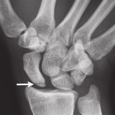 Ulnar Deviation X Ray