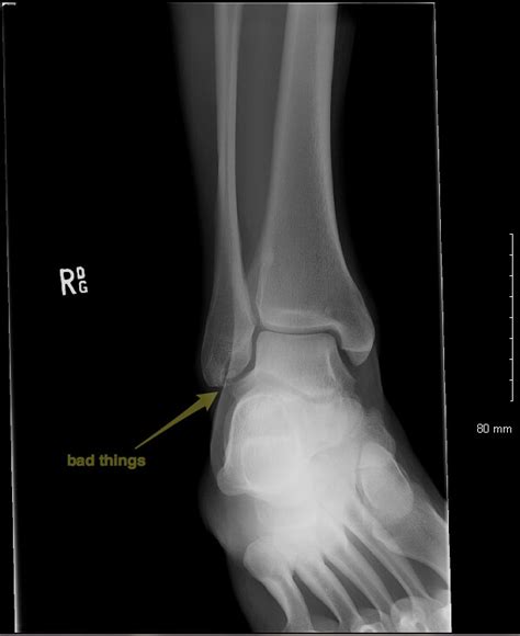 Fracture fibula - stormconcepts