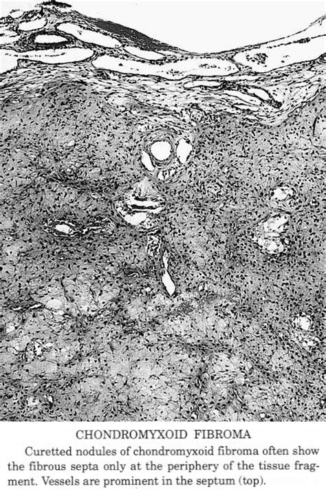 Pathology Outlines - Chondromyxoid fibroma