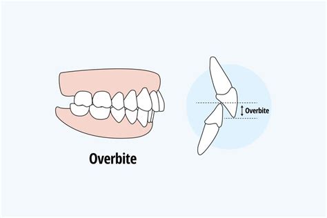 Can Invisalign Fix Overbite & How Long Does it Take? - Thurman Orthodontics