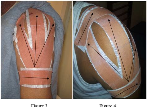 Physio for life: Physiotherapy Management of shoulder pain in patients with stroke