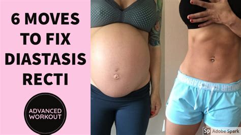 6 Exercises to Fix & Heal Diastasis Recti | ADVANCED Postpartum ...