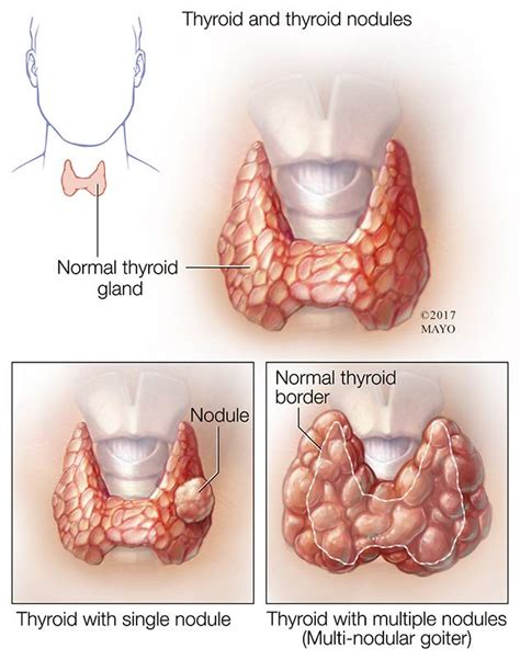 What is Hashimoto's disease? - Mayo Clinic News Network