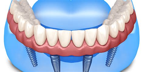 Advantages and Disadvantages of Getting Full Mouth Dental Implants - Phoenix Implant Center