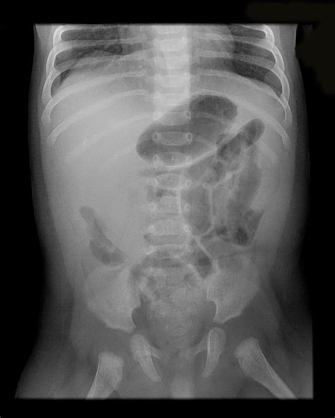 Abdominal X Ray Abnormalities Perforation Erect Chest - vrogue.co