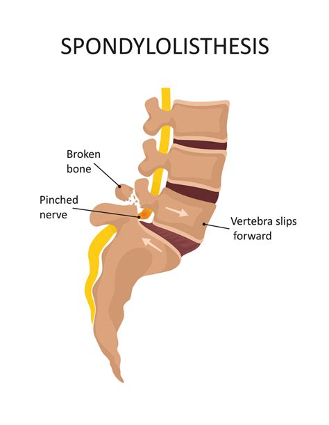 What is Spondylolisthesis? - JOI Jacksonville Orthopaedic Institute