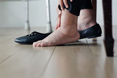 Common Causes of Swollen Feet – ActiveBeat – Your Daily Dose of Health ...