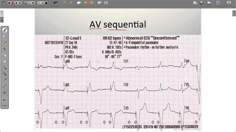 ECG Paced Rhythms - YouTube