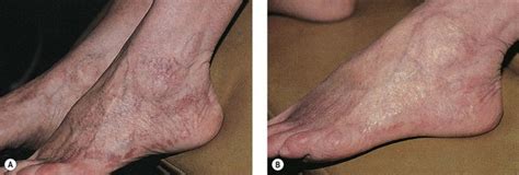 Treatment of Leg Telangiectasias with Laser and High-Intensity Pulsed Light | Clinical Gate