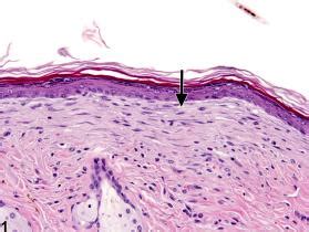 Skin - Fibrosis - Nonneoplastic Lesion Atlas