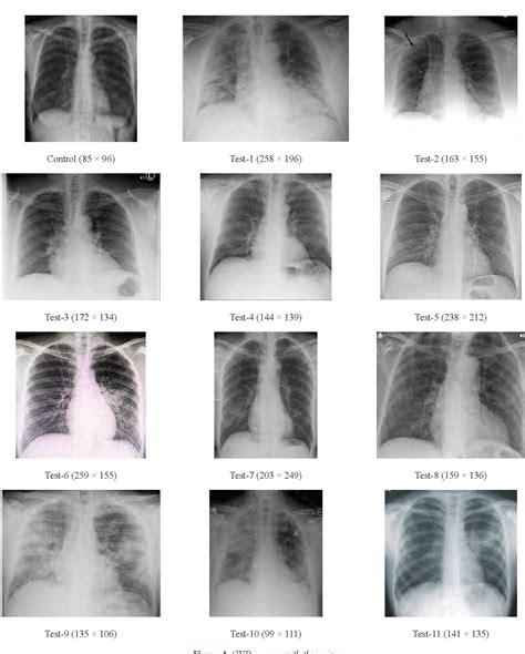 Figure 1 from A Novel Approach to Detect Abnormal Chest X-rays of COVID ...