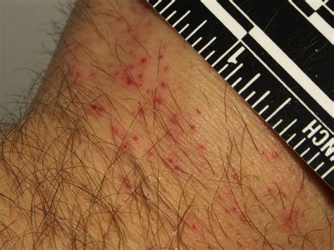 Bed Bug Rash: Symptoms and Treatment - PestSeek