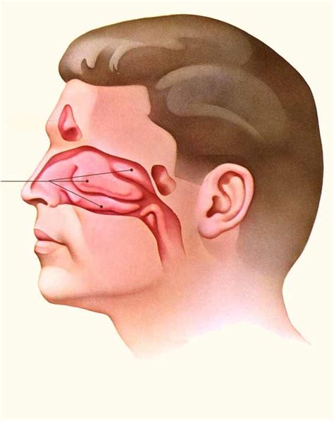 How to Find out If your Congested Nose is due to a Deviated Septum or ...