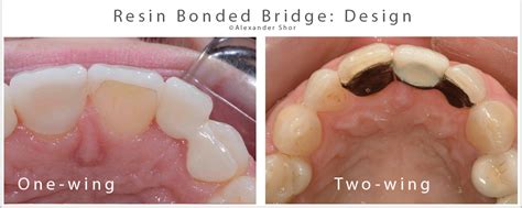 Resin Bonded Bridge: Minimally Invasive Option for Tooth Replacement - Shor Dental