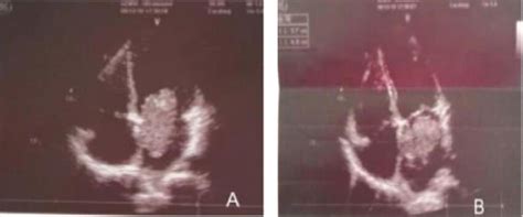 Preoperative transthoracic echocardiography (TTE) showing a ...