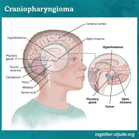 Craniopharyngioma in Children and Teens - Together by St. Jude™