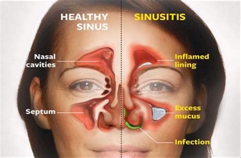 Kill Sinus Infection in 20 Seconds with This Simple Method and This Common Household Ingr ...