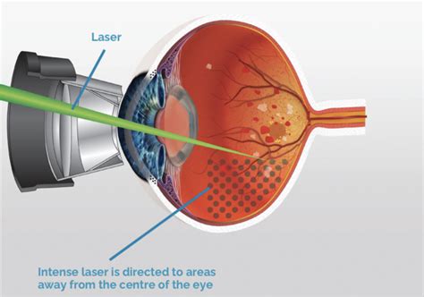 Retinal Hole Laser Treatment | Synergy Eye Care