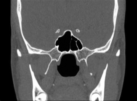 Normal Ct Scan Sinuses